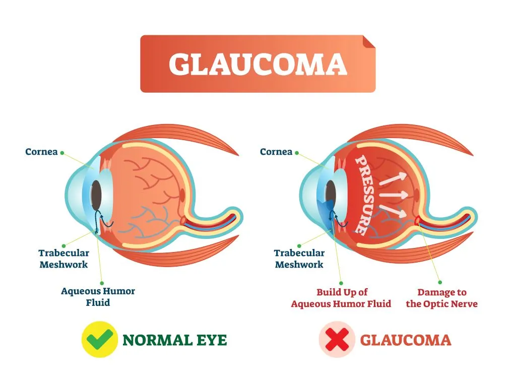 Glaucoma illustration